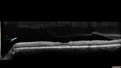 Severe Proliferative Diabetic Retinopathy and Good Vision
49 year old man with vision loss in the right eye for 2 weeks.  VA 20/40 OD, 20/63 OS.  DM x 15 years and HTN.
