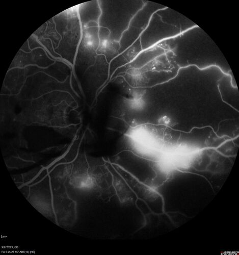 Severe Proliferative Diabetic Retinopathy and Good Vision
49 year old man with vision loss in the right eye for 2 weeks.  VA 20/40 OD, 20/63 OS.  DM x 15 years and HTN.
