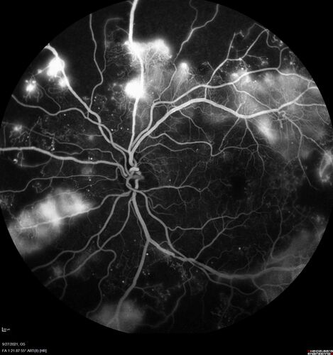 Severe Proliferative Diabetic Retinopathy and Good Vision
49 year old man with vision loss in the right eye for 2 weeks.  VA 20/40 OD, 20/63 OS.  DM x 15 years and HTN.

