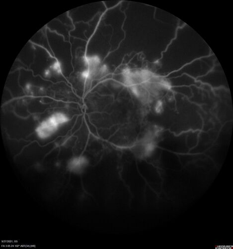 Severe Proliferative Diabetic Retinopathy and Good Vision
49 year old man with vision loss in the right eye for 2 weeks.  VA 20/40 OD, 20/63 OS.  DM x 15 years and HTN.
