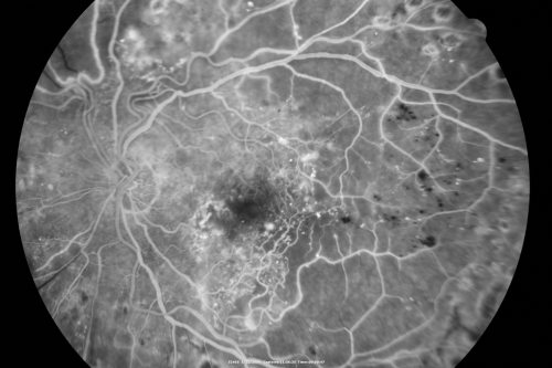 Diabetic Retinopathy - Non-Perfusion - Possible Central Retinal Vein Occlusion
68-year-old woman OD 20/70, OS 20/200 CYSTOID MACULAR EDEMA, POSSIBLE EITHER OCULAR ISCHEMIC SYNDROME IN THE RIGHT EYE OR OCCULT CENTRAL RETINAL VEIN OCCLUSION IN THE RIGHT EYE,S EVERE NON-PerfUSION WITH DIABETIC RETINOPATHY IN THE LEFT EYE.
Keywords: diabetic;non-perfusion;nonperfusion;central retinal vein occlusion