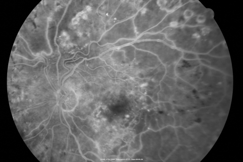 Diabetic Retinopathy - Non-Perfusion - Possible Central Retinal Vein Occlusion
68-year-old woman OD 20/70, OS 20/200 CYSTOID MACULAR EDEMA, POSSIBLE EITHER OCULAR ISCHEMIC SYNDROME IN THE RIGHT EYE OR OCCULT CENTRAL RETINAL VEIN OCCLUSION IN THE RIGHT EYE,S EVERE NON-PerfUSION WITH DIABETIC RETINOPATHY IN THE LEFT EYE.
Keywords: diabetic;non-perfusion;nonperfusion;central retinal vein occlusion