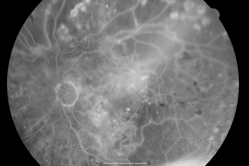 Diabetic Retinopathy - Non-Perfusion - Possible Central Retinal Vein Occlusion
68-year-old woman OD 20/70, OS 20/200 CYSTOID MACULAR EDEMA, POSSIBLE EITHER OCULAR ISCHEMIC SYNDROME IN THE RIGHT EYE OR OCCULT CENTRAL RETINAL VEIN OCCLUSION IN THE RIGHT EYE,S EVERE NON-PerfUSION WITH DIABETIC RETINOPATHY IN THE LEFT EYE.
Keywords: diabetic;non-perfusion;nonperfusion;central retinal vein occlusion