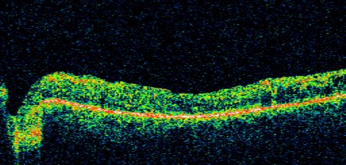 Diabetic Retinopathy - Non-Perfusion - Possible Central Retinal Vein Occlusion
68-year-old woman OD 20/70, OS 20/200 CYSTOID MACULAR EDEMA, POSSIBLE EITHER OCULAR ISCHEMIC SYNDROME IN THE RIGHT EYE OR OCCULT CENTRAL RETINAL VEIN OCCLUSION IN THE RIGHT EYE,S EVERE NON-PerfUSION WITH DIABETIC RETINOPATHY IN THE LEFT EYE.
Keywords: diabetic;non-perfusion;nonperfusion;central retinal vein occlusion