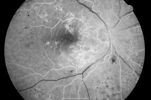 Diabetic Retinopathy - Non-Perfusion - Possible Central Retinal Vein Occlusion
68-year-old woman OD 20/70, OS 20/200 CYSTOID MACULAR EDEMA, POSSIBLE EITHER OCULAR ISCHEMIC SYNDROME IN THE RIGHT EYE OR OCCULT CENTRAL RETINAL VEIN OCCLUSION IN THE RIGHT EYE,S EVERE NON-PerfUSION WITH DIABETIC RETINOPATHY IN THE LEFT EYE.
Keywords: diabetic;non-perfusion;nonperfusion;central retinal vein occlusion