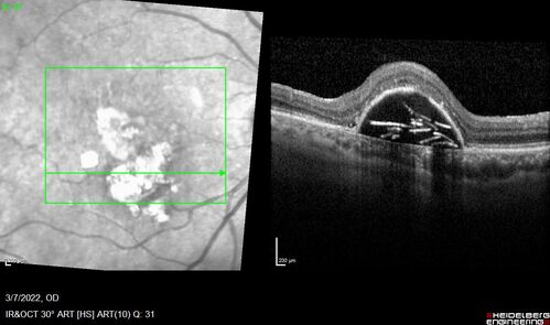 Pigment epithelial detachment with cholesterol crystals
Onion sign
