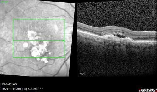 Pigment epithelial detachment with cholesterol crystals
Onion sign
