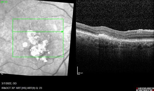 Pigment epithelial detachment with cholesterol crystals
Onion sign
