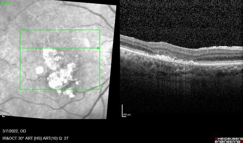 Pigment epithelial detachment with cholesterol crystals
Onion sign
