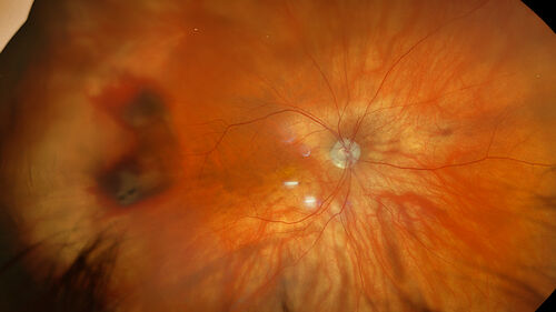 PEHCR - Peripheral Exudative Hemorrhagic Chorioretinopathy
