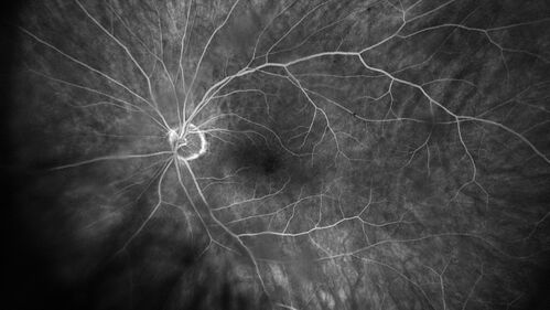 PEHCR - Peripheral Exudative Hemorrhagic Chorioretinopathy
