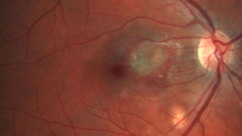 Punctate inner choroidopathy and CNVM
23 year old female noticed vision loss for 4 days.
VA 20/200 OD, 20/25 OS.
VA improved one month later to 20/40 with Avastin.  She received a second injection and was lost to follow-up
