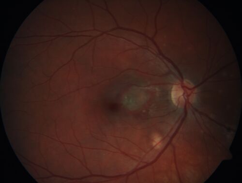Punctate inner choroidopathy and CNVM
23 year old female noticed vision loss for 4 days.
VA 20/200 OD, 20/25 OS.
VA improved one month later to 20/40 with Avastin.  She received a second injection and was lost to follow-up
