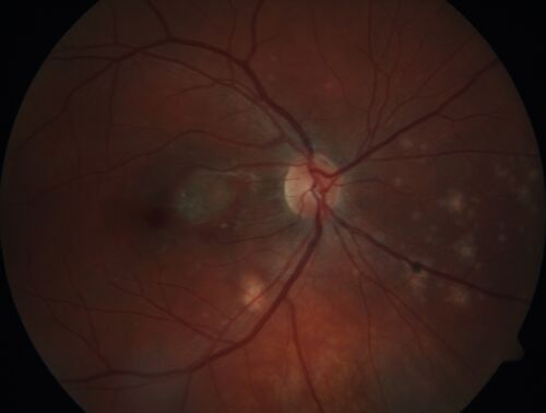 Punctate inner choroidopathy and CNVM
23 year old female noticed vision loss for 4 days.
VA 20/200 OD, 20/25 OS.
VA improved one month later to 20/40 with Avastin.  She received a second injection and was lost to follow-up
