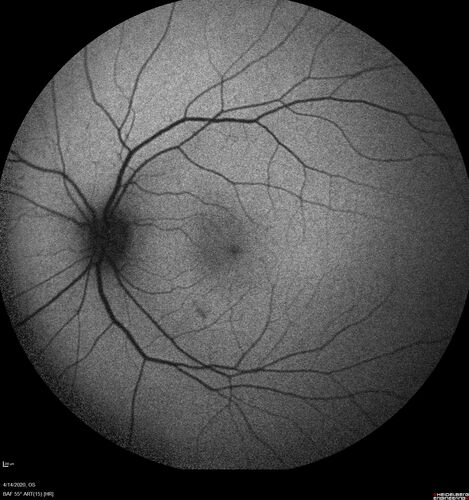 Punctate Inner Choroidopathy and Choroidal Neovascular Membrane (CNVM)
24 year old female She was doing fine until 4 days ago when the right eye fogged up on her.Â  The left eye is seeing fine.Â  In the end of January (3 months ago) she went to the doctor and got checked for everything and it was negative.Â  She had a bad cough at the time and no fevers that she knows of.Â Â 
VA OD: sc20/200+1, VA OS: sc20/25 - Uveitis work up was negative.  VA improved to 20/40 with a single avastin treatment and then the patient was lost to follow-up
