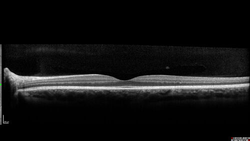 Punctate inner choroidopathy and CNVM
23 year old female noticed vision loss for 4 days.
VA 20/200 OD, 20/25 OS.
VA improved one month later to 20/40 with Avastin.  She received a second injection and was lost to follow-up

