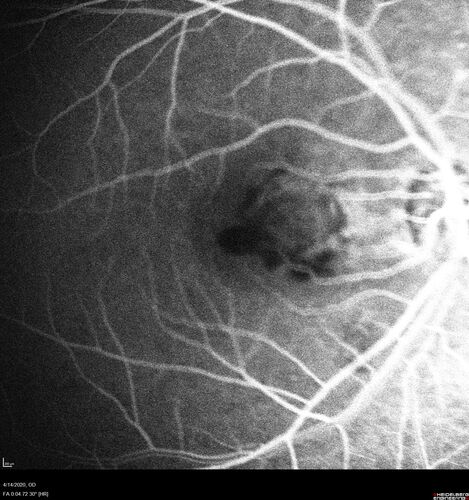 Punctate inner choroidopathy and CNVM
23 year old female noticed vision loss for 4 days.
VA 20/200 OD, 20/25 OS.
VA improved one month later to 20/40 with Avastin.  She received a second injection and was lost to follow-up
