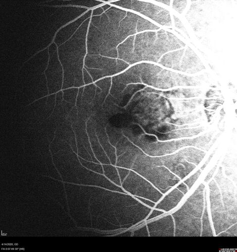 Punctate Inner Choroidopathy and Choroidal Neovascular Membrane (CNVM)
24 year old female She was doing fine until 4 days ago when the right eye fogged up on her.Â  The left eye is seeing fine.Â  In the end of January (3 months ago) she went to the doctor and got checked for everything and it was negative.Â  She had a bad cough at the time and no fevers that she knows of.Â Â 
VA OD: sc20/200+1, VA OS: sc20/25 - Uveitis work up was negative.  VA improved to 20/40 with a single avastin treatment and then the patient was lost to follow-up

