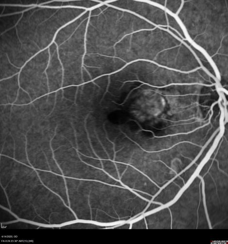 Punctate inner choroidopathy and CNVM
23 year old female noticed vision loss for 4 days.
VA 20/200 OD, 20/25 OS.
VA improved one month later to 20/40 with Avastin.  She received a second injection and was lost to follow-up
