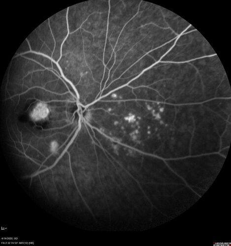 Punctate Inner Choroidopathy and Choroidal Neovascular Membrane (CNVM)
24 year old female She was doing fine until 4 days ago when the right eye fogged up on her.Â  The left eye is seeing fine.Â  In the end of January (3 months ago) she went to the doctor and got checked for everything and it was negative.Â  She had a bad cough at the time and no fevers that she knows of.Â Â 
VA OD: sc20/200+1, VA OS: sc20/25 - Uveitis work up was negative.  VA improved to 20/40 with a single avastin treatment and then the patient was lost to follow-up
