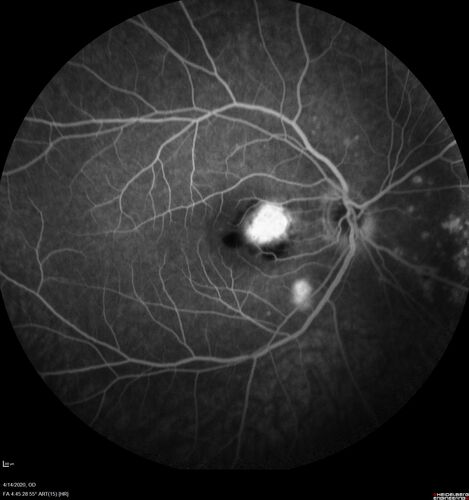 Punctate inner choroidopathy and CNVM
23 year old female noticed vision loss for 4 days.
VA 20/200 OD, 20/25 OS.
VA improved one month later to 20/40 with Avastin.  She received a second injection and was lost to follow-up
