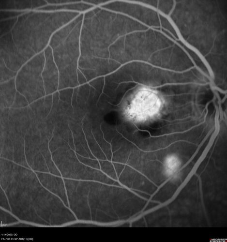 Punctate inner choroidopathy and CNVM
23 year old female noticed vision loss for 4 days.
VA 20/200 OD, 20/25 OS.
VA improved one month later to 20/40 with Avastin.  She received a second injection and was lost to follow-up

