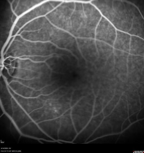 Punctate inner choroidopathy and CNVM
23 year old female noticed vision loss for 4 days.
VA 20/200 OD, 20/25 OS.
VA improved one month later to 20/40 with Avastin.  She received a second injection and was lost to follow-up
