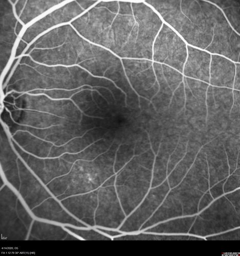Punctate inner choroidopathy and CNVM
23 year old female noticed vision loss for 4 days.
VA 20/200 OD, 20/25 OS.
VA improved one month later to 20/40 with Avastin.  She received a second injection and was lost to follow-up
