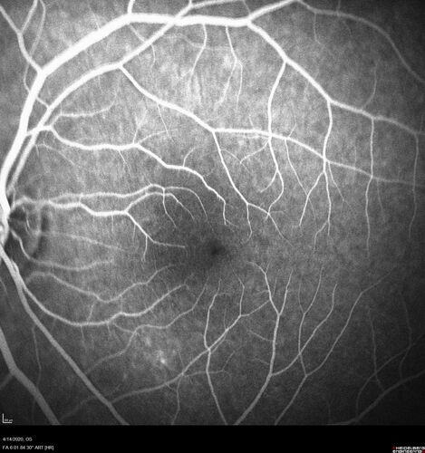 Punctate Inner Choroidopathy and Choroidal Neovascular Membrane (CNVM)
24 year old female She was doing fine until 4 days ago when the right eye fogged up on her.Â  The left eye is seeing fine.Â  In the end of January (3 months ago) she went to the doctor and got checked for everything and it was negative.Â  She had a bad cough at the time and no fevers that she knows of.Â Â 
VA OD: sc20/200+1, VA OS: sc20/25 - Uveitis work up was negative.  VA improved to 20/40 with a single avastin treatment and then the patient was lost to follow-up
