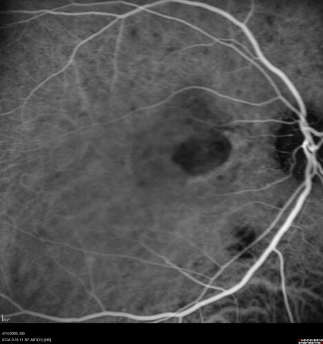 Punctate inner choroidopathy and CNVM
23 year old female noticed vision loss for 4 days.
VA 20/200 OD, 20/25 OS.
VA improved one month later to 20/40 with Avastin.  She received a second injection and was lost to follow-up
