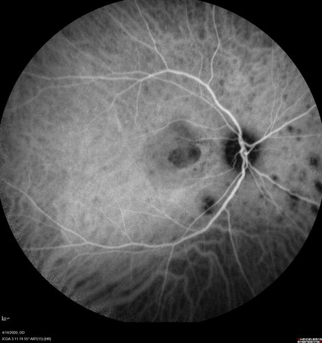 Punctate inner choroidopathy and CNVM
23 year old female noticed vision loss for 4 days.
VA 20/200 OD, 20/25 OS.
VA improved one month later to 20/40 with Avastin.  She received a second injection and was lost to follow-up
