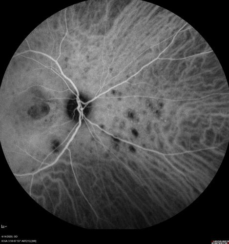 Punctate inner choroidopathy and CNVM
23 year old female noticed vision loss for 4 days.
VA 20/200 OD, 20/25 OS.
VA improved one month later to 20/40 with Avastin.  She received a second injection and was lost to follow-up
