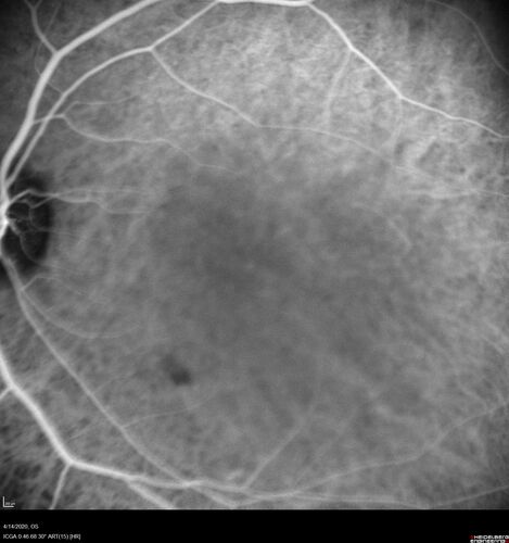 Punctate inner choroidopathy and CNVM
23 year old female noticed vision loss for 4 days.
VA 20/200 OD, 20/25 OS.
VA improved one month later to 20/40 with Avastin.  She received a second injection and was lost to follow-up
