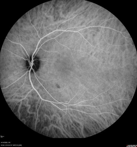 Punctate Inner Choroidopathy and Choroidal Neovascular Membrane (CNVM)
24 year old female She was doing fine until 4 days ago when the right eye fogged up on her.Â  The left eye is seeing fine.Â  In the end of January (3 months ago) she went to the doctor and got checked for everything and it was negative.Â  She had a bad cough at the time and no fevers that she knows of.Â Â 
VA OD: sc20/200+1, VA OS: sc20/25 - Uveitis work up was negative.  VA improved to 20/40 with a single avastin treatment and then the patient was lost to follow-up
