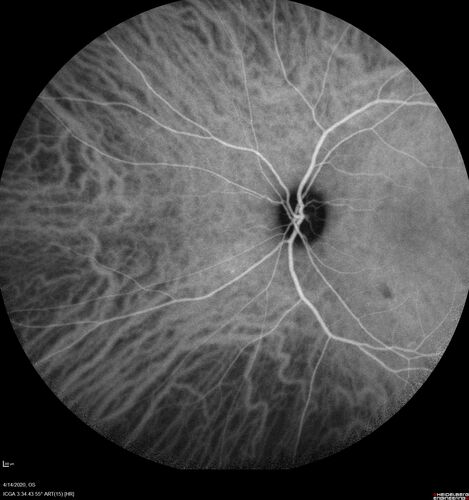 Punctate inner choroidopathy and CNVM
23 year old female noticed vision loss for 4 days.
VA 20/200 OD, 20/25 OS.
VA improved one month later to 20/40 with Avastin.  She received a second injection and was lost to follow-up
