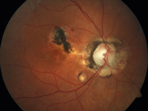 Macular Scars from Presumed Ocular Histoplasmosis Syndrome
85 year old man 
He sometimes sees double vision.  When he sees people walking they are sometimes double for about 6 months.  
VA OD: sc20/25 PH20/20 NccJ3
VA OS: sc20/20-2 NccJ2
IOP: TP: OD:12 OS:14
