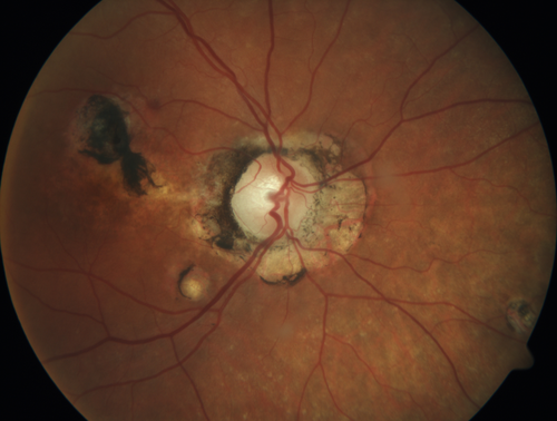 Macular Scars from Presumed Ocular Histoplasmosis Syndrome
85 year old man 
He sometimes sees double vision.  When he sees people walking they are sometimes double for about 6 months.  
VA OD: sc20/25 PH20/20 NccJ3
VA OS: sc20/20-2 NccJ2
IOP: TP: OD:12 OS:14
