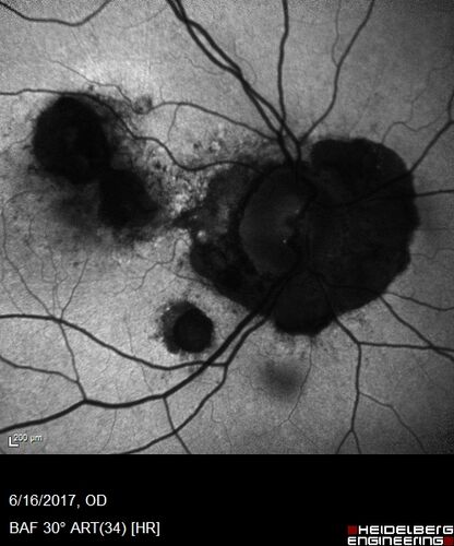 Macular Scars from Presumed Ocular Histoplasmosis Syndrome
85 year old man 
He sometimes sees double vision.  When he sees people walking they are sometimes double for about 6 months.  
VA OD: sc20/25 PH20/20 NccJ3
VA OS: sc20/20-2 NccJ2
IOP: TP: OD:12 OS:14
