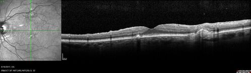 Macular Scars from Presumed Ocular Histoplasmosis Syndrome
85 year old man 
He sometimes sees double vision.  When he sees people walking they are sometimes double for about 6 months.  
VA OD: sc20/25 PH20/20 NccJ3
VA OS: sc20/20-2 NccJ2
IOP: TP: OD:12 OS:14
