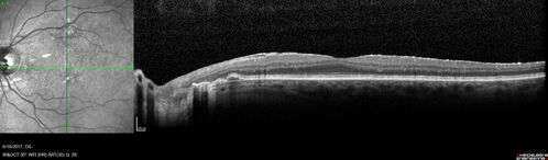 Macular Scars from Presumed Ocular Histoplasmosis Syndrome
85 year old man 
He sometimes sees double vision.  When he sees people walking they are sometimes double for about 6 months.  
VA OD: sc20/25 PH20/20 NccJ3
VA OS: sc20/20-2 NccJ2
IOP: TP: OD:12 OS:14
