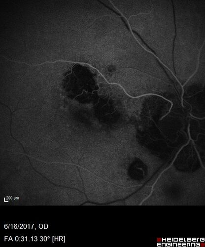 Macular Scars from Presumed Ocular Histoplasmosis Syndrome
85 year old man 
He sometimes sees double vision.  When he sees people walking they are sometimes double for about 6 months.  
VA OD: sc20/25 PH20/20 NccJ3
VA OS: sc20/20-2 NccJ2
IOP: TP: OD:12 OS:14
