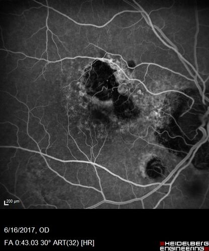 Macular Scars from Presumed Ocular Histoplasmosis Syndrome
85 year old man 
He sometimes sees double vision.  When he sees people walking they are sometimes double for about 6 months.  
VA OD: sc20/25 PH20/20 NccJ3
VA OS: sc20/20-2 NccJ2
IOP: TP: OD:12 OS:14
