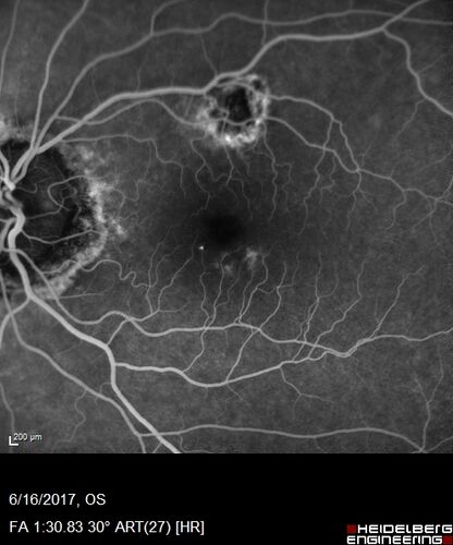 Macular Scars from Presumed Ocular Histoplasmosis Syndrome
85 year old man 
He sometimes sees double vision.  When he sees people walking they are sometimes double for about 6 months.  
VA OD: sc20/25 PH20/20 NccJ3
VA OS: sc20/20-2 NccJ2
IOP: TP: OD:12 OS:14
