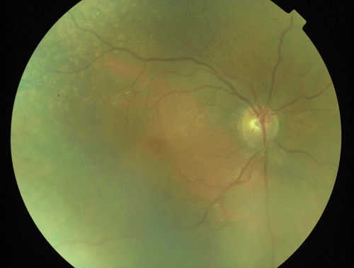 Uveitis and Retinal Whitening - 04-27-12 - Prior to PPV OD - Possible Primary Ocular Lymphoma 
