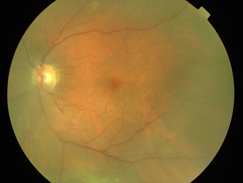 Uveitis and Retinal Whitening - 04-27-12 - Prior to PPV OD - Possible Primary Ocular Lymphoma 
