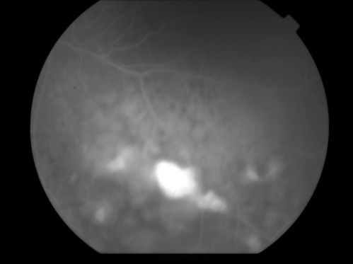 Uveitis and Retinal Whitening - 04-27-12 - Prior to PPV OD - Possible Primary Ocular Lymphoma 
