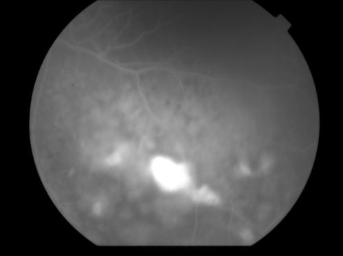 Uveitis and Retinal Whitening - 04-27-12 - Prior to PPV OD - Possible Primary Ocular Lymphoma 
