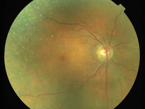 Primary Ocular Lymphoma - 051812 
