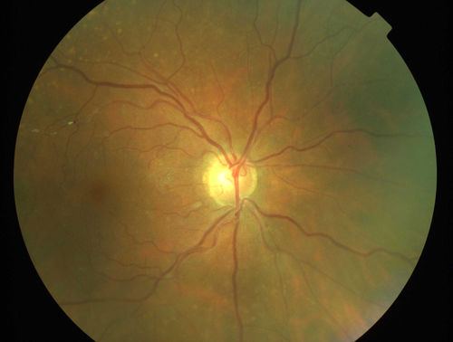 Primary Ocular Lymphoma - 051812 
