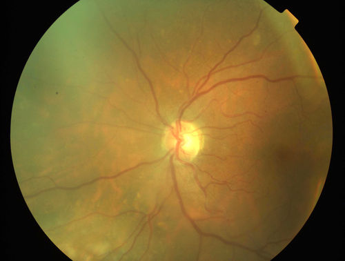Primary Ocular Lymphoma - 051812 
